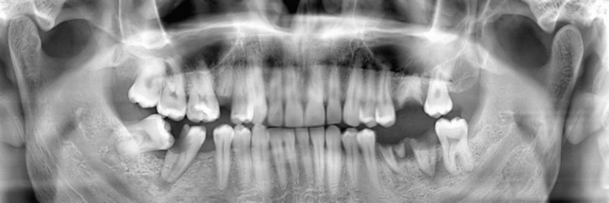 Spokane Options for Replacing Missing Teeth